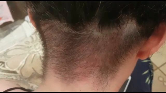 Пересадка волос. Подготовка донорской зоны у женщин. смотреть онлайн