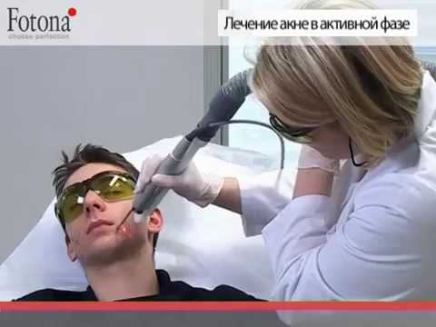 Лазерное лечение акне лазером Fotona