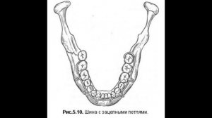 Консервативные методы лечения переломов нижней челюсти и верхней челюсти