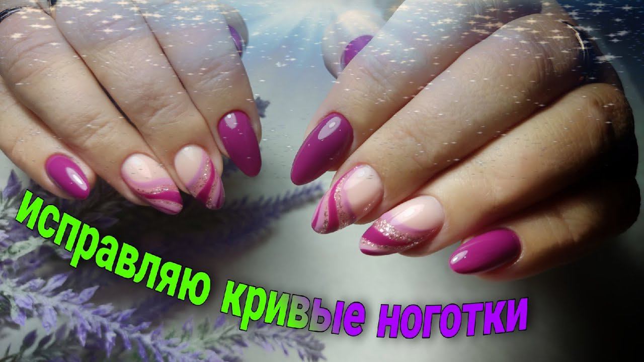 Коррекция растущих вбок ногтей
