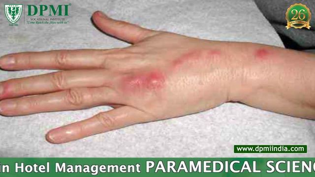 Candidiasis: What is Candidiasis? Candida Species– Morphology? Pathogenesis of Candida Albicans смотреть онлайн