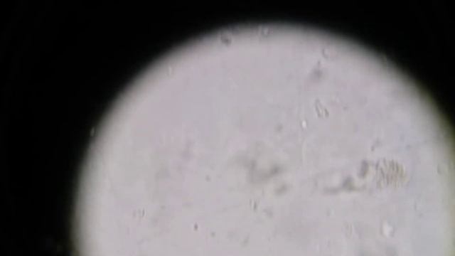 цилиндрурия зернистые цилиндры