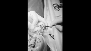 Подногтевой экзостоз - решение проблемы