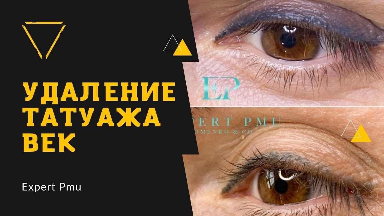 Лазерное удаление татуажа : до и сразу после