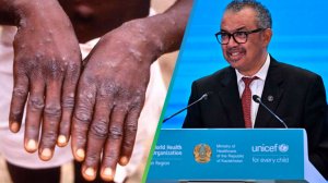 ВОЗ признал вспышку оспы обезьян в Африке чрезвычайной ситуацией международного масштаба