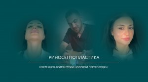 Риносептопластика для пациентки доктора Беликова