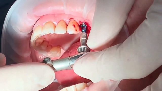 Удаление зуба и сразу имплант смотреть онлайн