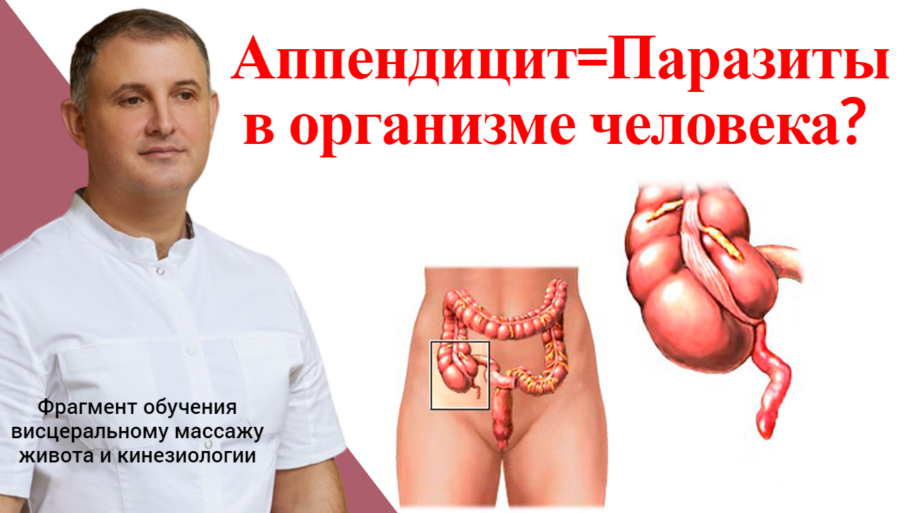 Аппендицит=Паразиты в организме человека? Лечение и профилактика с позиций висцерального массажа и к