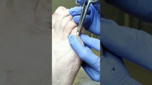 Обработка стержневой мозоли на мизинце, подолог Ольга Кострюкова