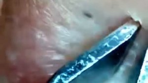 Самое мерзкое видео на ютубе!!!!The most disgusting video on YouTube!!!! Давка прыщей !Acne crush!