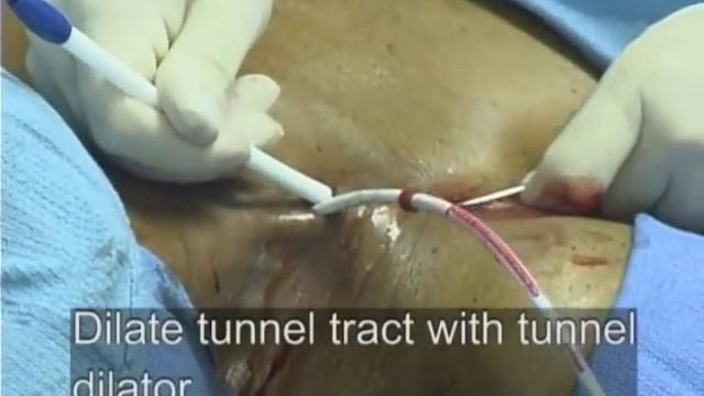 Установка перманентного диализного катетера CannonIIPlus смотреть онлайн