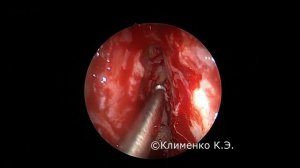 Эндоскопическая полисинусотомия. Полипозный риносинусит. Endoscopic sinus surgery. Nasal polyposis.