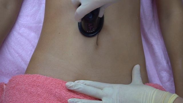 массаж вакуумными банками Si-Line смотреть онлайн