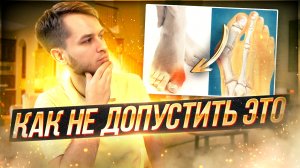 Упражнения и массаж от косточки.Вальгусная деформация.