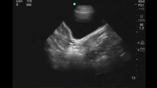 Порядок выполнения: ультразвуковое исследование FAST — женский таз смотреть онлайн