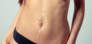 Диастаз. Причины. Симптомы. Лечение. Пластический хирург Николай Константинов