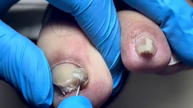Pull out a big nail! Onychomycosis crazily embeds to the root【Pedicure Master Lin Jun】 смотреть онлайн