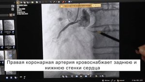 Баллонная ангиопластика и стентирование правой коронарной артерии при коронарографии.