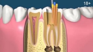 Качественное лечение каналов зубов под микроскопом