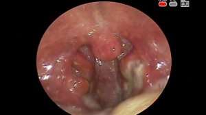 ЯЗВЕННО - НЕКРОТИЧЕСКАЯ #АНГИНА ОСТРЫЙ #БАКТЕРИАЛЬНЫЙ #ТОНЗИЛЛИТ ЛОР ВРАЧ КЛИНИКА ОБРАЗЦОВА