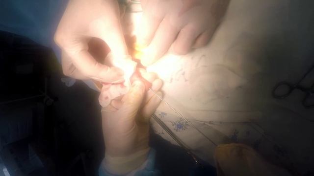 Устранение сгибательной постожоговой контрактуры пальца кисти