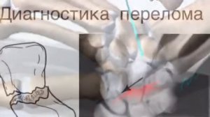 Перелом ладьевидной кости