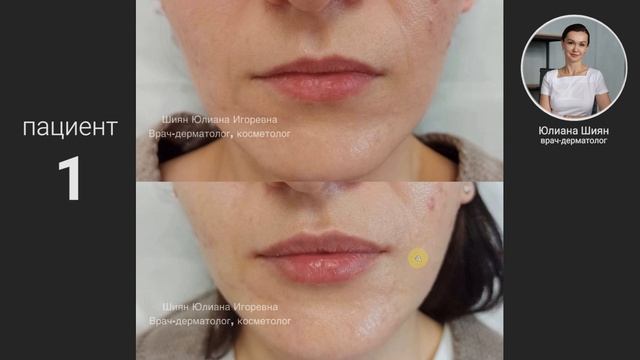 Коррекция губ До и После смотреть онлайн