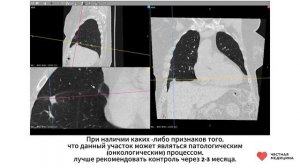 Компьютерная томография органов грудной клетки