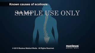 Scoliosis ¦ Scoliosis Surgery ¦ Nucleus Health смотреть онлайн