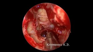 Эндоскопическая расширенная полисинусотомия Full House FESS