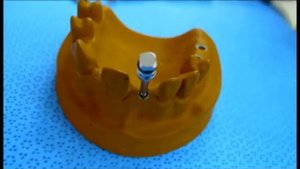 Извлечение сломанного абатментаИзвлечение сломанного абатмента