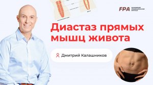 Диастаз прямых мышц живота | Дмитрий Калашников (FPA)