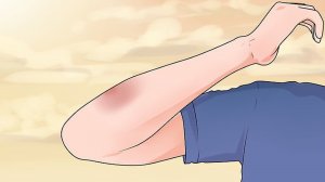 Как убрать СИНЯК с тела? Три действенных средства!