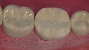 Препарирование моляра нижней челюсти под цельнолитую коронку из золотосодержащего сплава