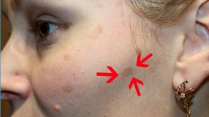 АПТЕЧНАЯ МАЗЬ от ПИГМЕНТНЫХ ПЯТЕН Сода и Касторовое масло  от ПИГМЕНТАЦИИ и ВЕСНУШЕК на лице