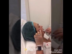 Процедура Радиесс. Филлер Радиесс в скулы. А Клиника.