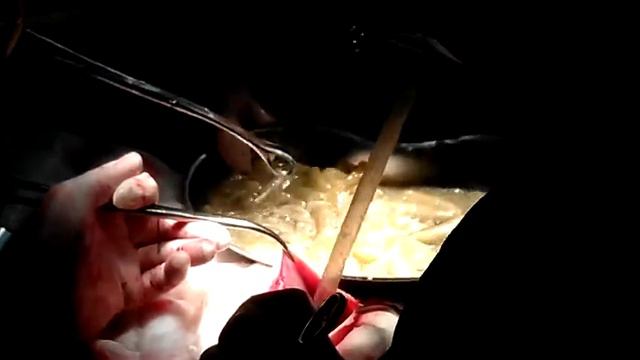 Ehinokokkoz pecheni 480 смотреть онлайн