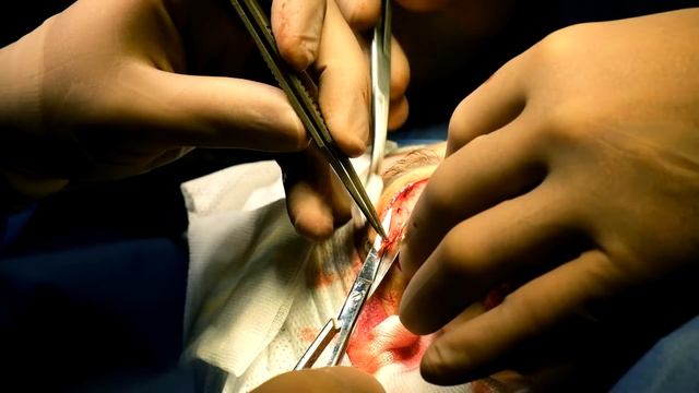 Коротко о пластике век | Верхняя блефаропластика смотреть онлайн