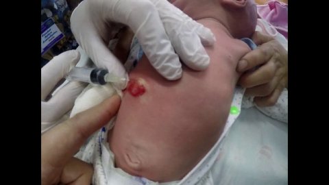 Склеротерапия гемангиомы