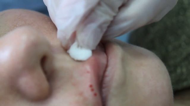 Техника Парижских губ Контурная пластика