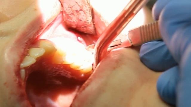 Удаление зубов "мудрости". Профессор Орлов А.А. смотреть онлайн