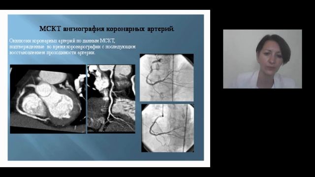 Факультетская  терапия. Ишемическая Болезнь Сердца (ИБС):   стенокардия 09.09.2020