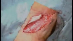 Каротидная эндартерэктомия