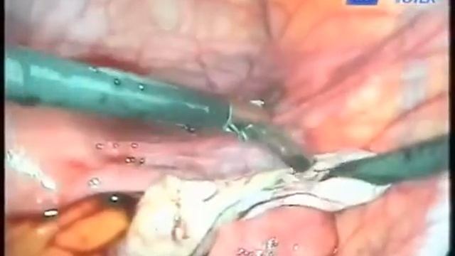 Вылущивание кисты правого яичника смотреть онлайн