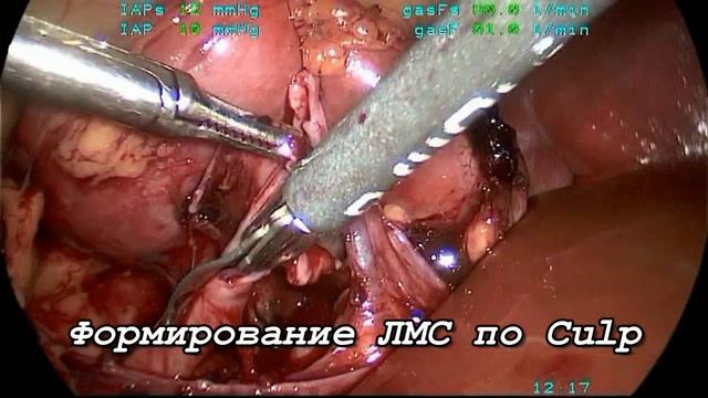 Особенности пиелопластики при дистопии и гиперротации почек