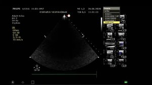 УЗИ СОСУДОВ ГОЛОВЫ И ШЕИ НОРМА