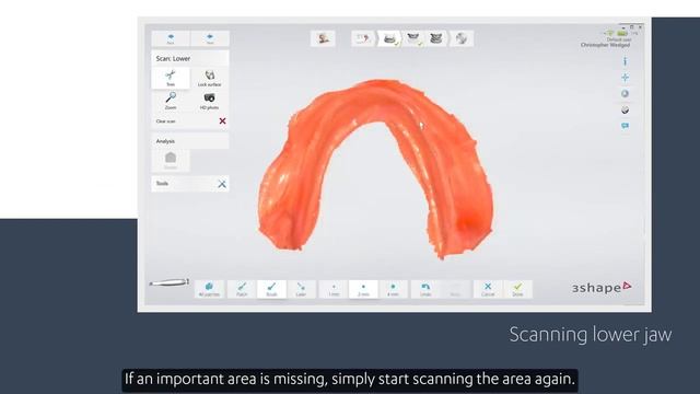 3Shape TRIOS Scan Strategy Edentulous patient