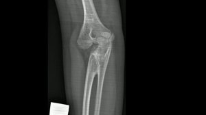 СИНОСТОЗ луче-локтевой. Рентген анатомия