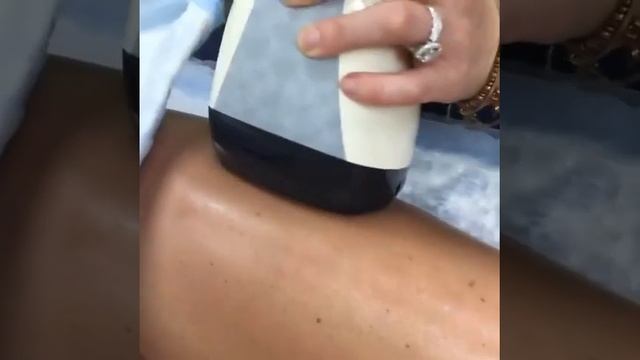 Velashape Machine in Action on Legs Thighs смотреть онлайн