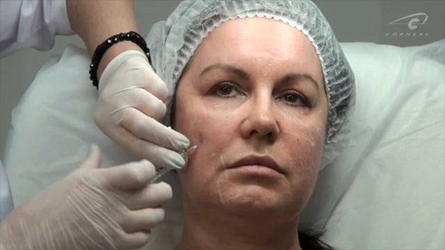 Техника работы канюлей. Обучение контурной пластике "Корнеаль". смотреть онлайн